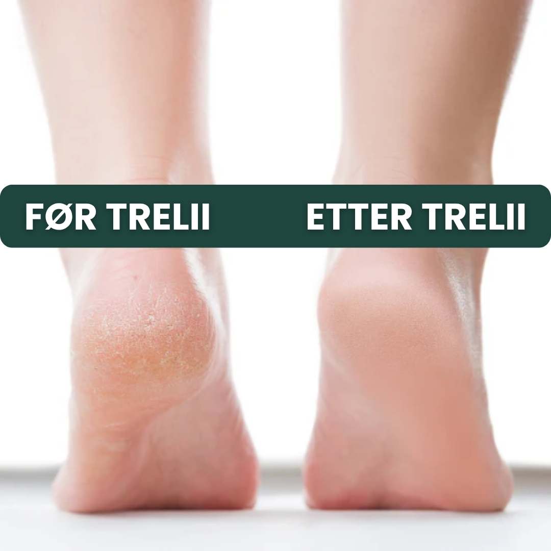 Trelii Förhårdnad-sborttagare